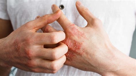How Do I Remedy The Painful Eczema Irritation Mayo Clinic News Network