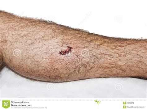 Stitches Stock Image Image Of Medical Wounded Scar 26082973