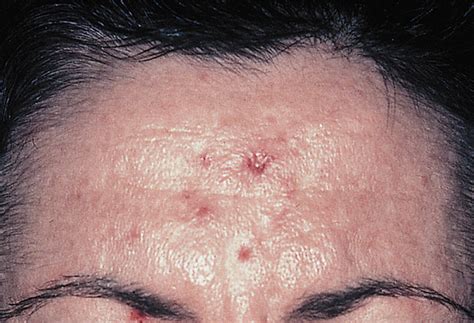 Herpetic Folliculitis And Syringitis Simulating Acne Excoriée Acne