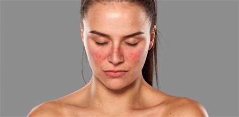 Symptoms vary between people and may be mild to severe. Systemic Lupus Erythematosus Evaluation Program - CubaHeal