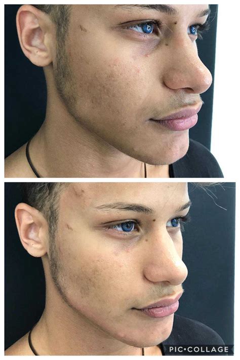 Denis dosio, lo youtuber 18enne che è stato più volte vittima di aggressioni, parla delle minacce di denis dosio si scaglia contro gli haters che, non solo lo offendono sui social, ma lo hanno anche. Denis Dosio da Giacomo Urtis per ritoccarsi la faccia - le foto prima e dopo - RETE 7