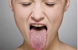 Itchy Tongue And Roof Of Mouth Photos