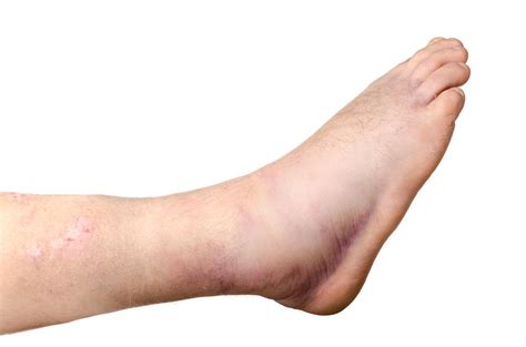 Blood Clot Symptoms Foot Dvt Treatment Glen Mills Pa Vein Center