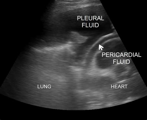 6 The Pericardium Pre Reading For Fcus Course Intensive Care Network