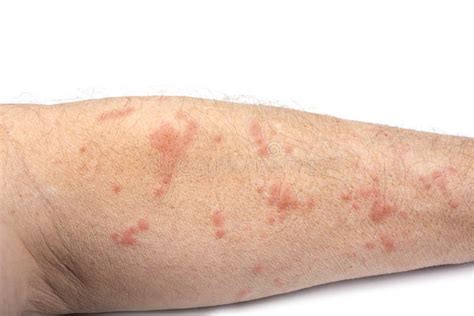 Skin Disease Rash On A Man Arm Stock Photo Image Of Dermatitis