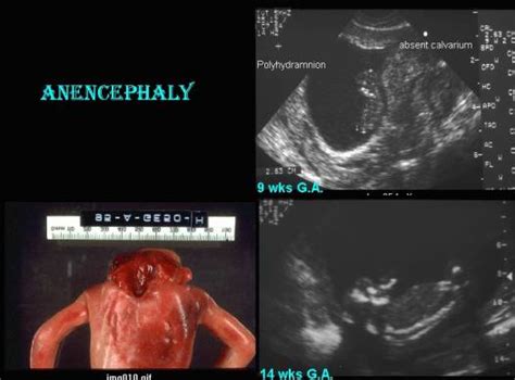 Anencephaly Ultrasound