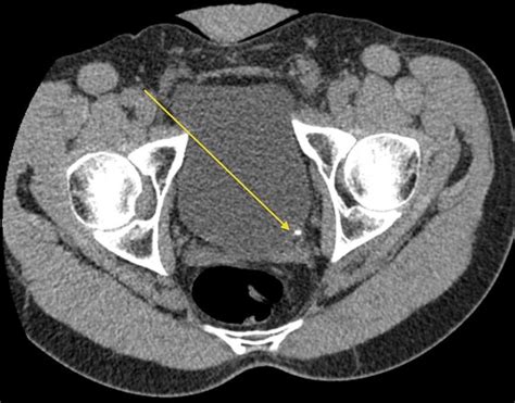 Vesico Ureteric Obstruction Diagnosed On Plain Abdominal Radiography