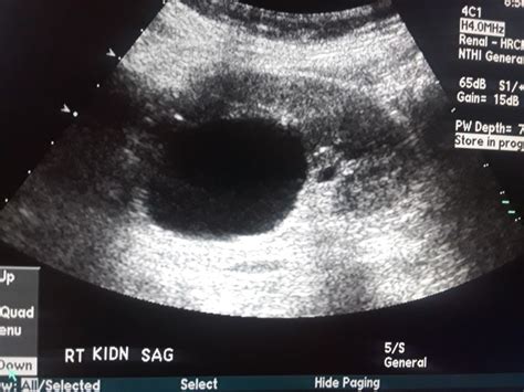 Simple Renal Cyst Renal Cysts Ultrasound