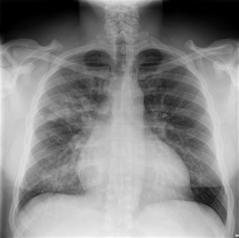 Bronchopneumonia Definition Causes Symptoms Diagnosis