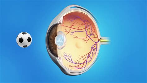 Yag Capsulotomy After Cataract Surgery Youtube