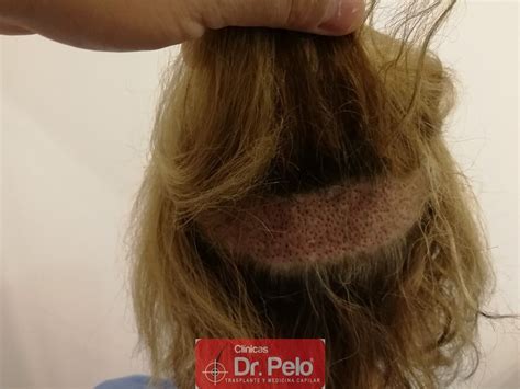 Injerto capilar con la técnica FUE en mujer- SEVILLA, BADAJOZ, MADRID