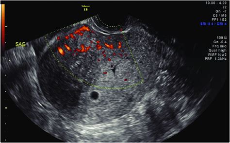Transvaginal Color Doppler Image Of Adenomyosis Note Asymmetric
