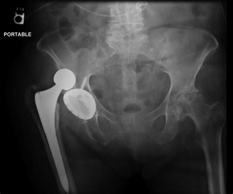 Dislocated Right Total Hip Arthroplasty Download Scientific Diagram