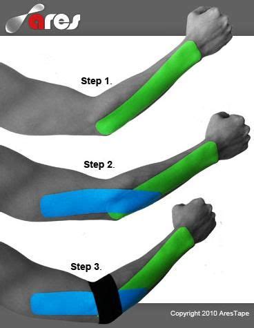 Using kinesio tape for tennis elbow is an excellent treatment option for lateral epicondylitis, or tennis elbow, which involves using kinesiology tape to reduce symptoms. www.acupuncture-sales.com en products-mainmenu-64 15 ...