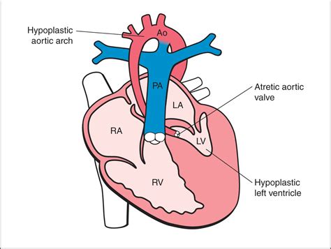 What Is Lv In The Heart Literacy Basics