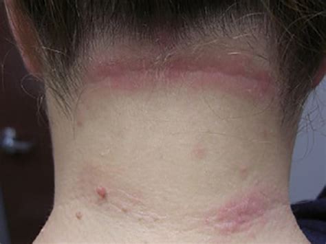 Eczema Pictures And Images What It Looks Like Eczema Living