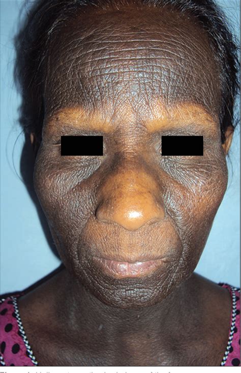 Figure 1 From A Rare Case Of Malignant Acanthosis Nigricans In A Lady