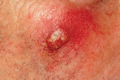 Die größe liegt üblicherweise zwischen 0,8 und 1,2 µm. Staphylococcus aureus infection with PVL toxin | GPonline