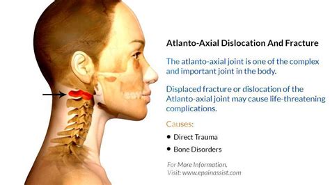 Atlanto Occipital Joint