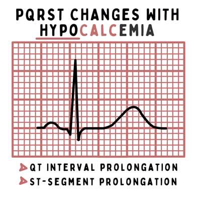 Hypocalcemia Guide For Nurses Nursing Assessment And Management