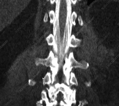 Conus Medullaris On Ct Myelogram Stock Image C0393916 Science