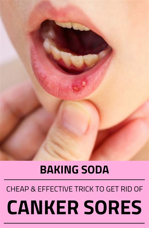 Baking Soda Cheap And Effective Trick To Get Rid Of Canker Sores