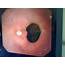 Active Prepyloric Ulcer Endoscopic View – DrRaad Alsaffar