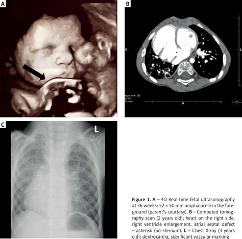 Figure 1 From Successful Atrial Septal Defect Transcatheter Closure In
