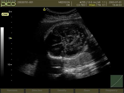 Ultrasound Images • Fetal Head B Mode Echogramm №253
