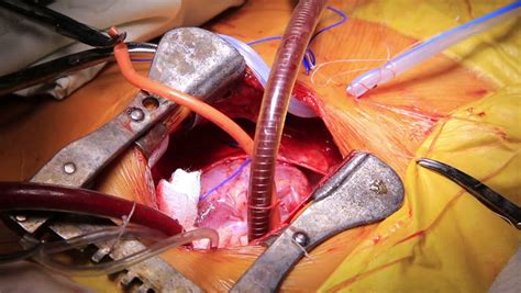 Closeup Of Coronary Artery Bypass Graft Surgery 4k