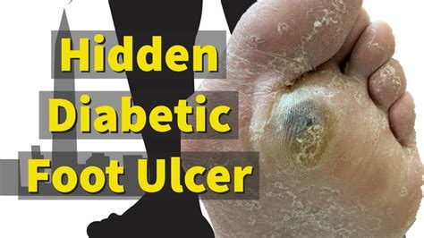 Hidden Diabetic Foot Ulcer Youtube
