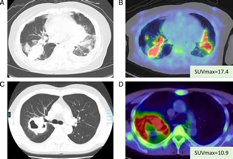 Three Different Ct And Fdg Petct Findings Of Pulmonary Involvement In
