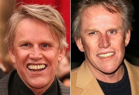 Celebs With Bad Teeth How Far Did They Go Their Dental Implants Cost