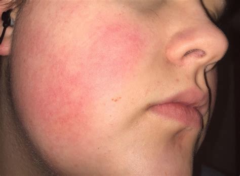 Skin Concerns Routine Help Help Evening Out Red Cheeks