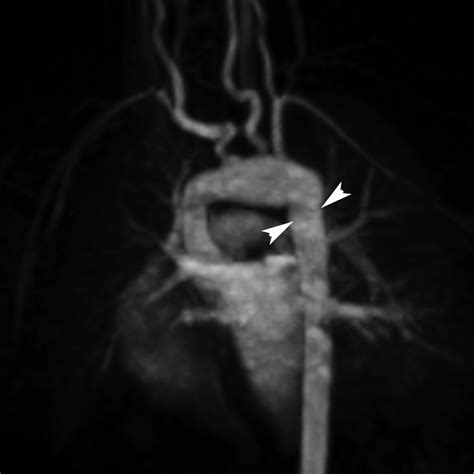 Surgical And Endovascular Repair Of Aortic Coarctation Normal Findings