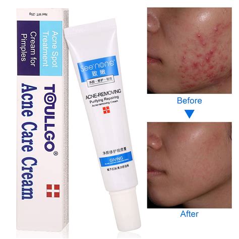 Cystic Acne Treatment Acne Treatment Cream Acne Cream Acne Acne