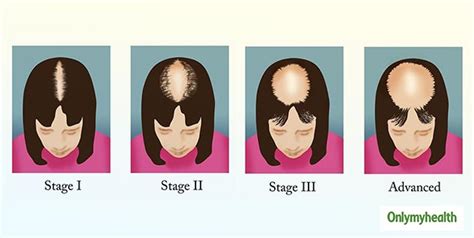 Female Pattern Hair Loss Symptoms Stages And Treatment Onlymyhealth