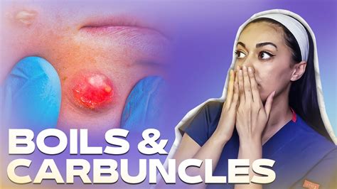 How To Get Rid Of Boils And Carbuncles┃signs Symptoms Causes And