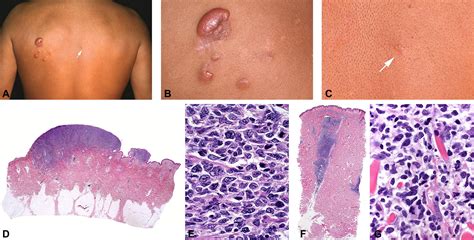 Clinicopathologic Features Of Early Lesions Of Primary Cutaneous