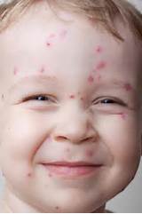 Can Kids Get Shingles Images