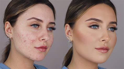 Is Makeup Bad For Acne Scars