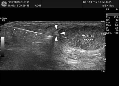 Transverse Sonogram Through The Posterior Ankle Initial Lidocaine