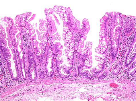Sessile Serrated Adenoma Histology