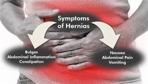 Hernias After Wls Causes Symptoms And Treatments Obesityhelp