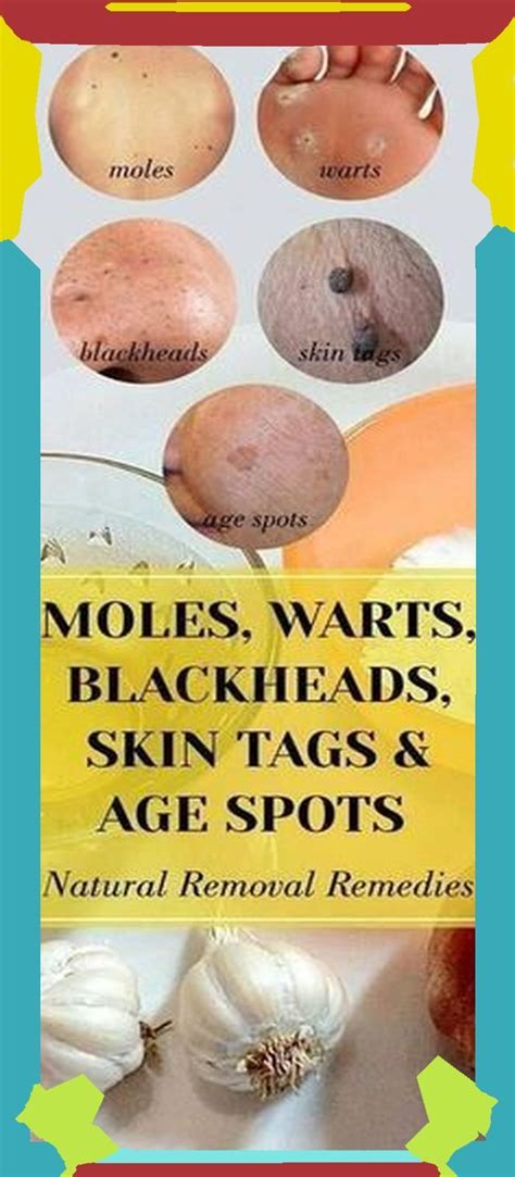 Warts On Hands Warts On Face Mole Removal Skin Tag Removal What
