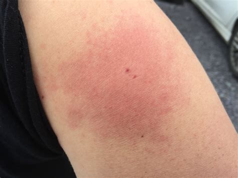 Negative Reaction To A Horsefly Bite My Recovery Experience Patient