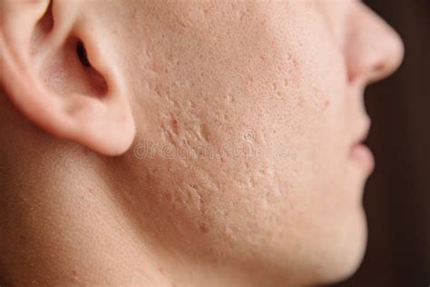 Acne Scars On The Face Stock Image Image Of Health 180490179