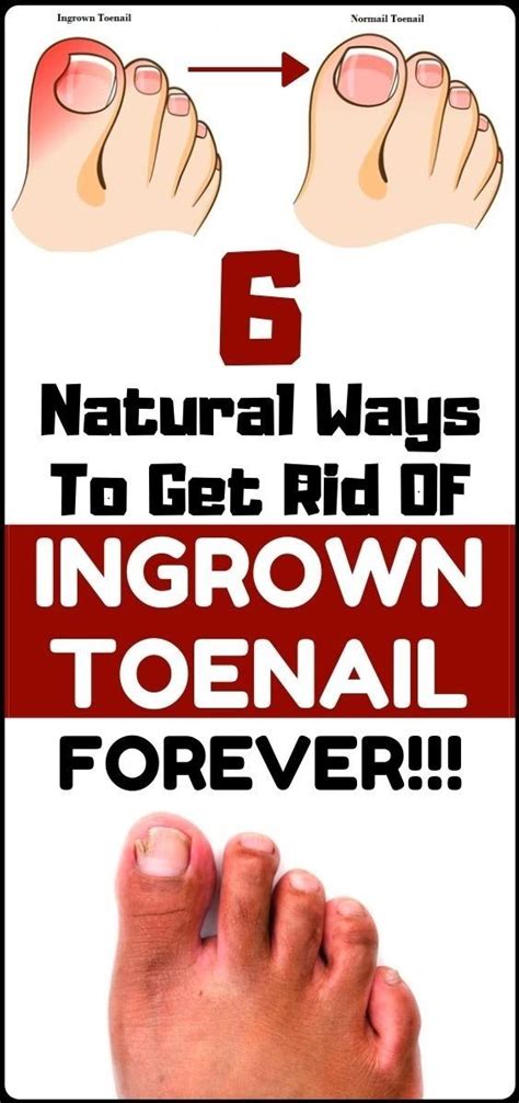 Solve Your Ingrown Toenail With These 6 Natural And Homemade Remedies