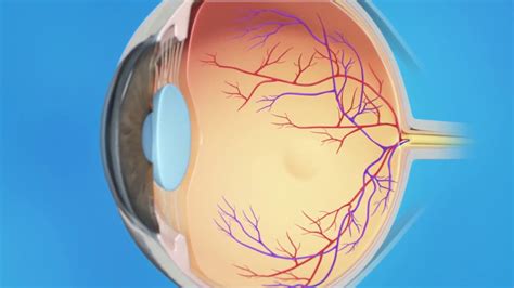 A retina can tear just like a piece of cloth. Torn Retina: Cryopexy - YouTube