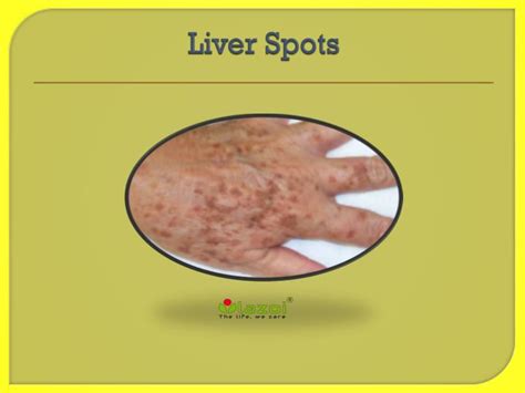 Liver Spots Pictures Liver Spots Causes Symptoms Treatment Liver